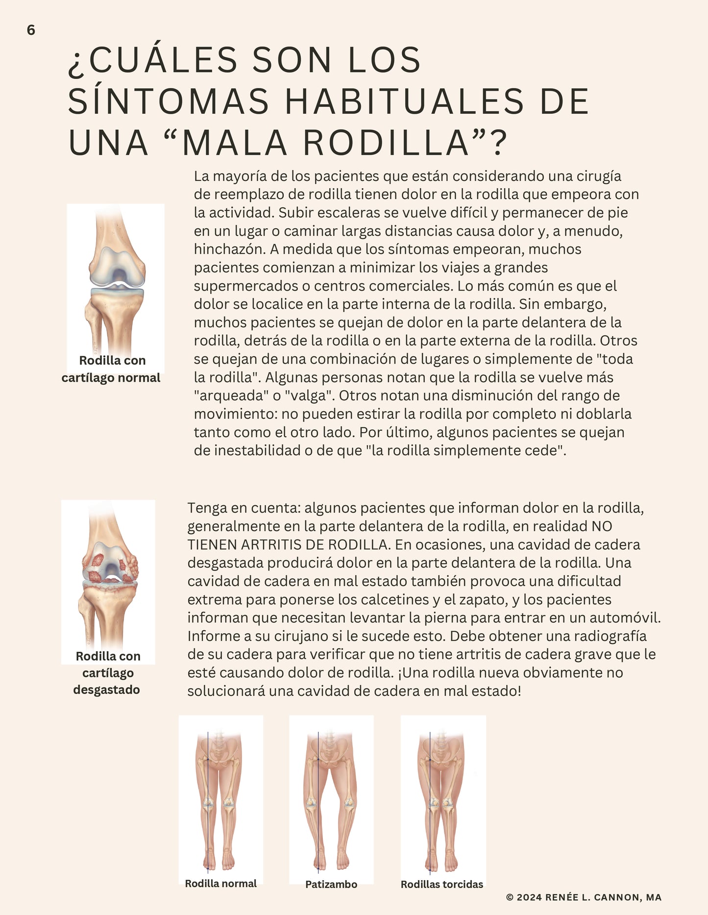 TOTAL KNEE - LESS SWELLING  LESS PAIN (SPANISH VERSION)