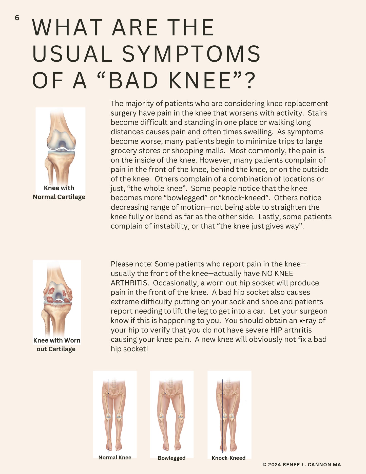 TOTAL KNEE - LESS SWELLING  LESS PAIN